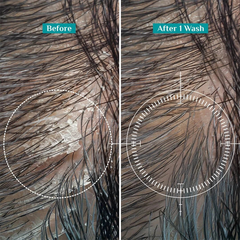 Australian Tea Tree Non-Drying Anti-Dandruff Shampoo
Reduces Dandruff Without Drying Hair
